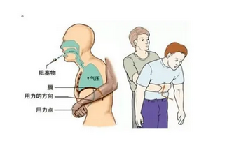 遇到异物卡住喉咙,可采取海姆立克急救法。海姆立克急救法是科学解除气道异物堵塞的急救方法,分为成人版操作和儿童版操作两种急救方法(图1) 遇到异物卡住喉咙,可采取海姆立克急救法。海姆立克急救法是科学解除气道异物堵塞的急救方法,分为成人版操作和儿童版操作两种急救方法(图1)